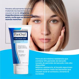 Limpiador Facial Cremoso para Acné Panoxyl 170 Gramos 2 Unidades
