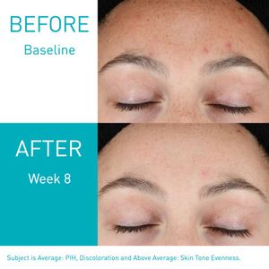 Resurfacing Retinol Serum Cerave Acné 30ml
